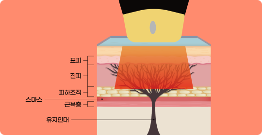 SHR MODE 진피층 이미지