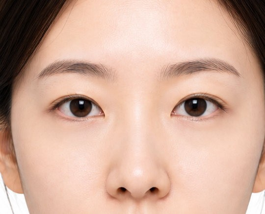 눈밑지방제거 첫 번째 수술 후
