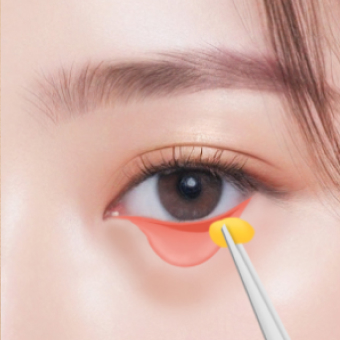 눈밑지방제거 시술